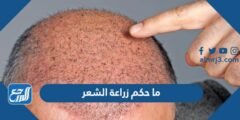 ما حكم زراعة الشعر