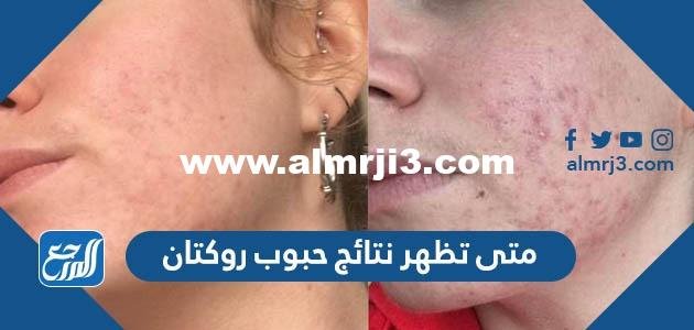 متى تظهر نتائج حبوب روكتان