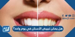 هل يمكن تبييض الأسنان في يوم واحد ؟