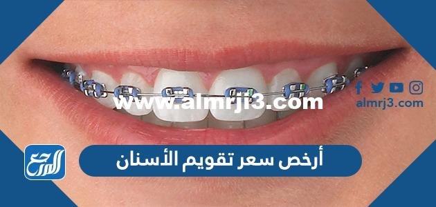 أرخص سعر تقويم الأسنان 2024 في السعودية