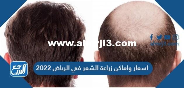 اسعار واماكن زراعة الشعر في الرياض 2024