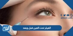 الفيلر تحت العين قبل وبعد