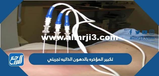 تكبير المؤخره بالدهون الذاتيه تجربتي - موقع المرجع