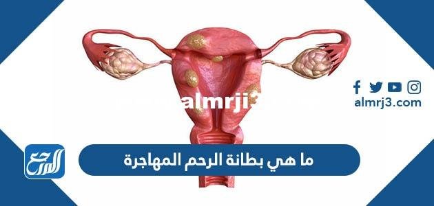 ما هي بطانة الرحم المهاجرة بالصور