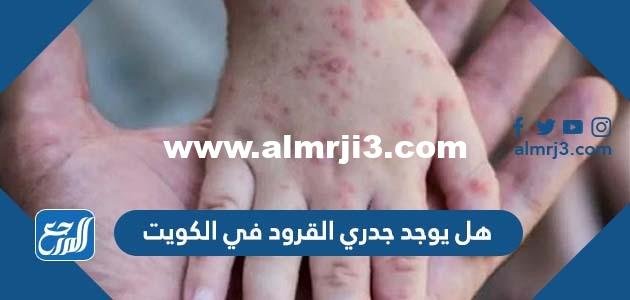 هل يوجد جدري القرود في الكويت 2026
